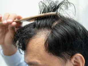 Hair loss treatment for men